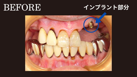 チタン金属床義歯＋インプラントオーバーデンチャーの部分入れ歯の症例