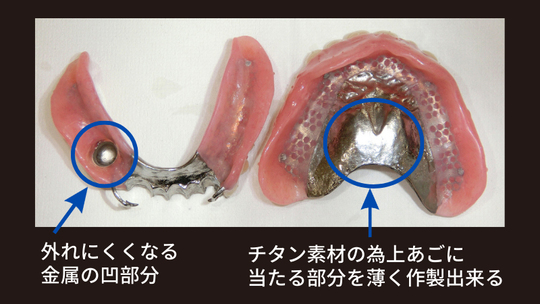 治療義歯＋チタン金属床義歯・コーヌス冠の部分入れ歯・総入れ歯の症例