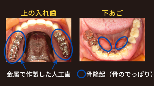 チタン金属床義歯の総入れ歯の症例「入れ歯がよく壊れる」 - しげた歯科医院 松原入れ歯専門外来