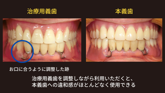 治療義歯＋チタン金属床義歯・コーヌス冠の部分入れ歯・総入れ歯の症例